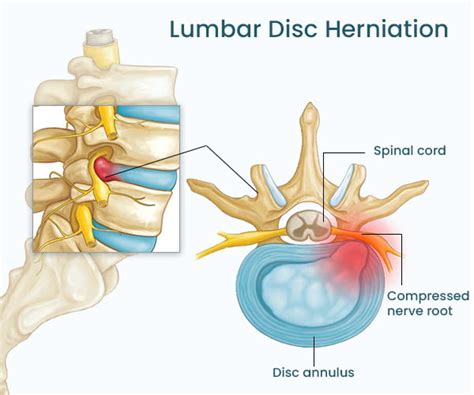 Prevención y manejo de la hernia de disco: el papel de la discectomía