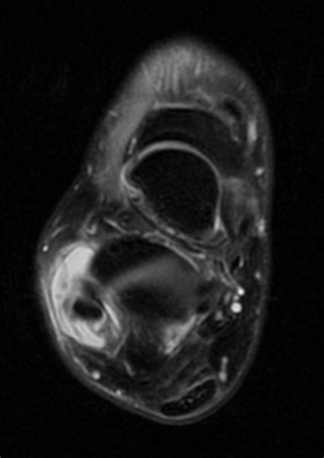 Split Peroneus Brevis Tendon-MRI - Sumer's Radiology Blog