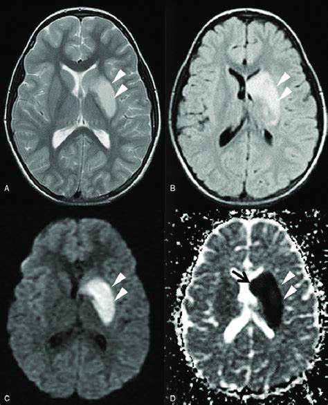 Varicella leading to basal ganglia stroke. A 7-year-old girl with... | Download Scientific Diagram