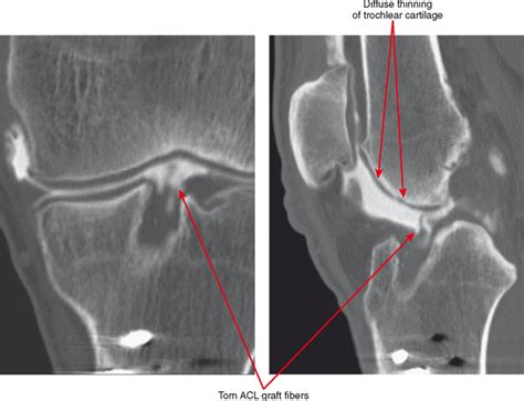 ARTHROGRAPHY AND JOINT INJECTION AND ASPIRATION: Principles and ...