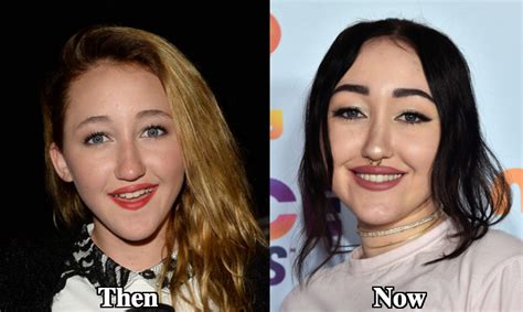 Noah Cyrus Plastic Surgery Before and After Photos - Latest Plastic Surgery Gossip And News ...