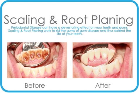 Dentist in State College | Scaling and Root Planing in State College | Dentistry by April Detar