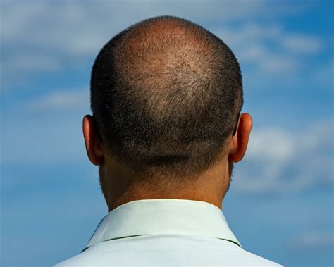 Dealing with a balding crown: why it happens and how to treat it - myhair