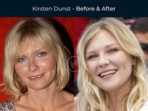 Kirsten Dunst Plastic Surgery Before After Breast Implants | The Best Porn Website