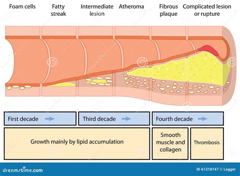 Atheroma Formation Stock Vector - Image: 61318147