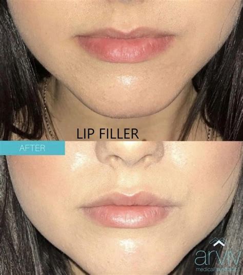 Dermal Fillers & Lip Injection Tampa | Arviv Medical Aesthetics