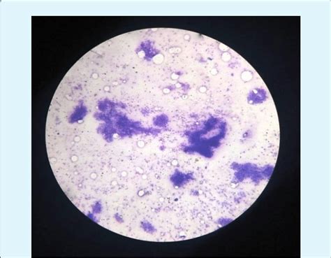 FNAC of Axillary Lump-Cellular aspirate, bimodal cell population,... | Download Scientific Diagram