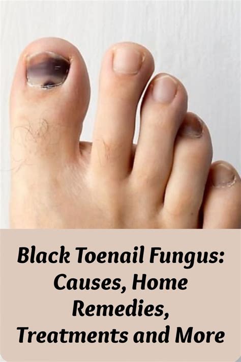 Black Toenail Fungus: Causes, Home Remedies, Treatments And More in 2021 | Black toenail fungus ...