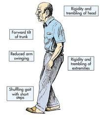 Parkinson's disease gait changes | Parkinsons disease, Parkinsons symptoms, Heart disease prevention