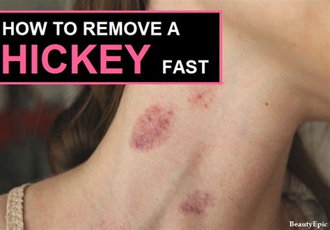 Top 10 Easy Ways To Get Rid Of A Hickey Overnight In 2024