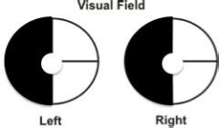 All Lesions to Visual Pathways SSOM Flashcards - Cram.com