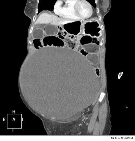 Giant Mesenteric Cyst as a Cause of Intestinal Obstruction | Cirugía Española (English Edition)