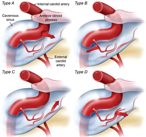 Bệnh Carotid–Cavernous Fistula: Nguyên nhân, biến chứng và cách điều trị