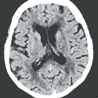 Large right extra-axial hemorrhage with midline shift and small ...