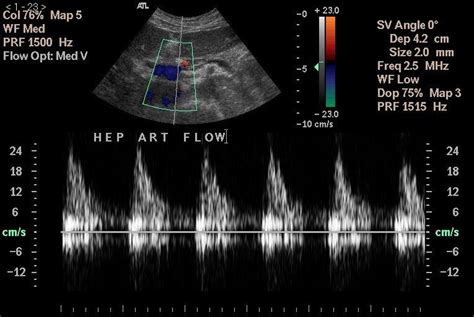 Common Hepatic Artery Ultrasound