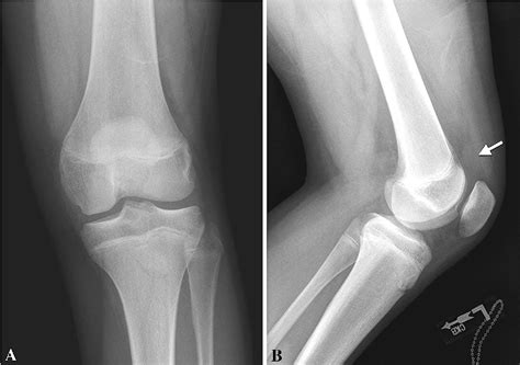 Left Knee Pain and Bilateral Knee Swelling in an Adolescent | Semantic Scholar