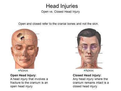 Phineas Gage luckily suffered an open head injury, otherwise he likely would have died.