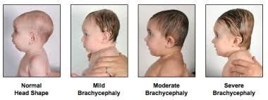 Brachycephaly