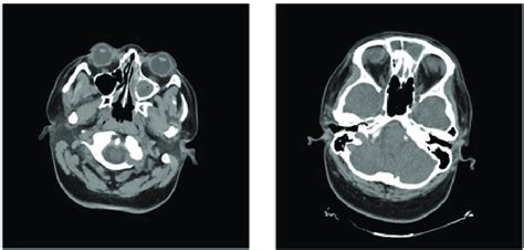 Admission CT with complete opacification of the left frontal sinus and ...