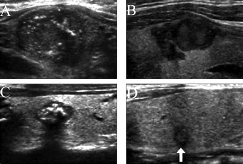 Medullary Thyroid Cancer