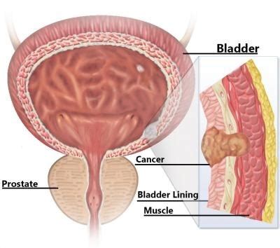 Muscle Invasive Bladder Cancer (MIBC) Diagnosis and Treatment