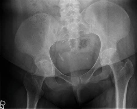 Degenerative Joint Diseases – Hip – Undergraduate Diagnostic Imaging Fundamentals