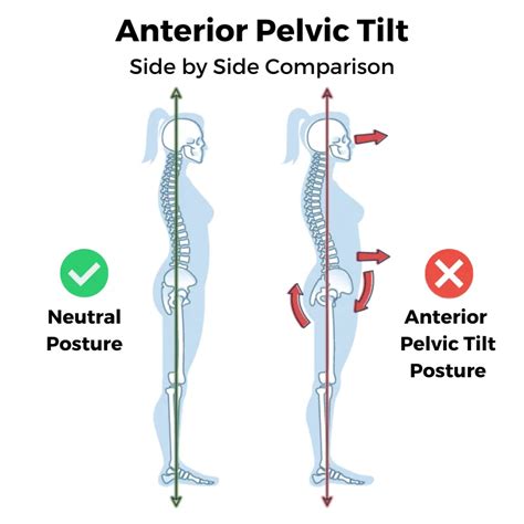 Anterior Tilt Causing Pain? Try These Anterior Pelvic Tilt Tests