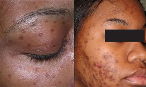 Skin discoloration causes and dark or white skin discoloration treatment