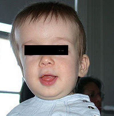 Craniosynostosis - Causes, Symptoms, Types, Pictures, Diagnosis, Treatment