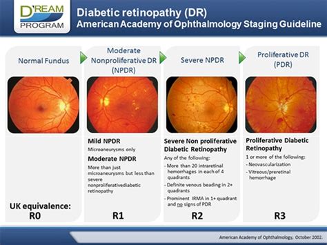 Current Challenges in Diabetic Retinopathy: Early Diagnosis and Ways to Improve its Outcome