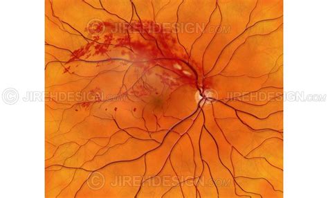 Branch retinal vein occlusion BRVO - #CO0095 - Stock eye images