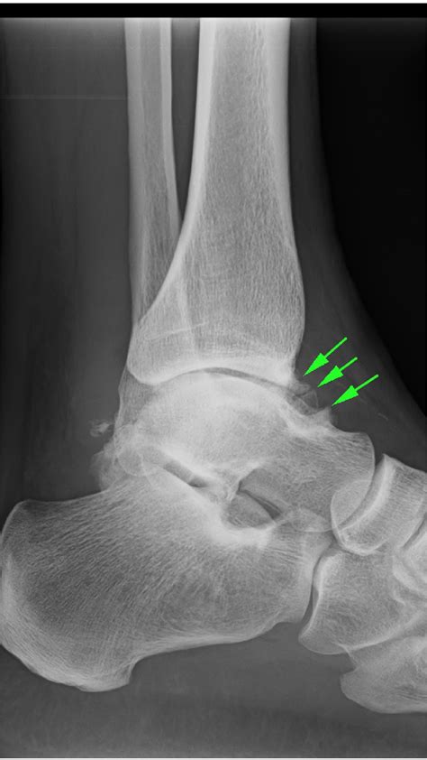 Chronic Ankle Instability FAQs | Foot and Ankle | Doctor Articles | Asia Medical Specialists