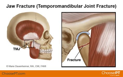 Guide | Physical Therapy Guide to Jaw Fracture (Temporomandibular Joint Fracture) (2023)