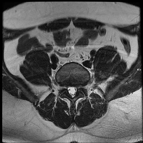 Ankylosing spondylitis MRI - wikidoc