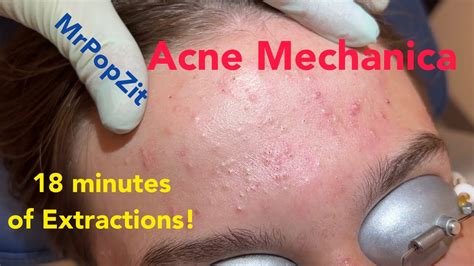 Acne Mechanica. Over 18 minutes of blackhead extractions! Common with football players. - YouTube