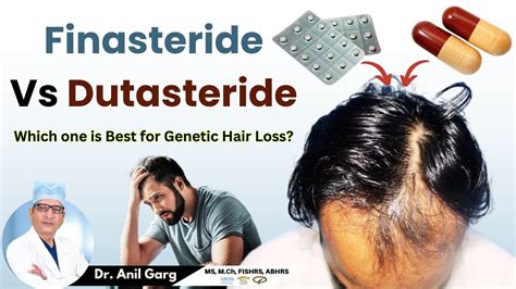 Finasteride Vs Dutasteride | (Finasteride और Dutasteride में फरक क्या है) Side-effects - YouTube