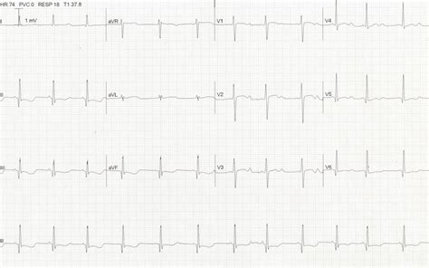 QT Interval • LITFL • ECG Library Basics