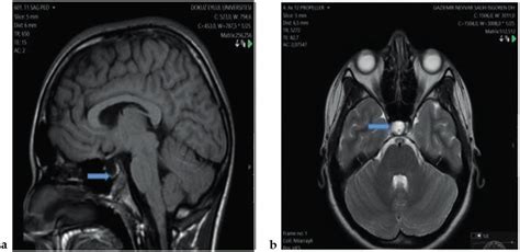 MRI brain scans of patient number 7. a. Midsagittal T1-weighted image ...