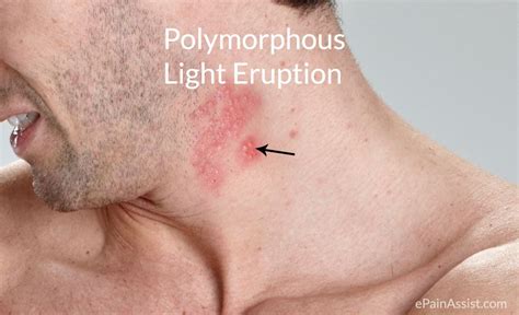 Polymorphous Light Eruption (PLE) or Polymorphic Light Eruption (PMLE) | Pmle treatment, Skin ...