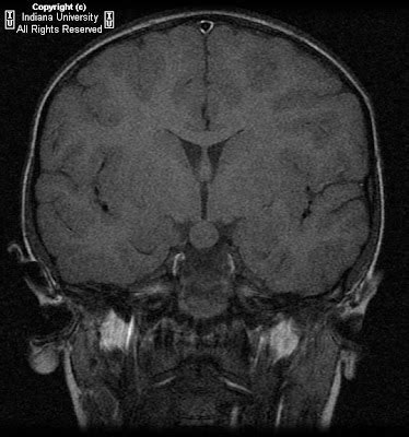 Neuroradiology On the Net: Tuber cinereum hamartoma