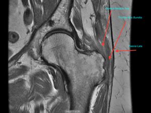 Bursa Hip Mri