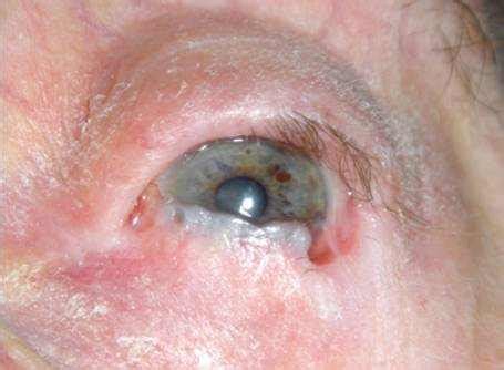 Ocular Cicatricial Pemphigoid: Causes, Diagnosis, Treatment Options