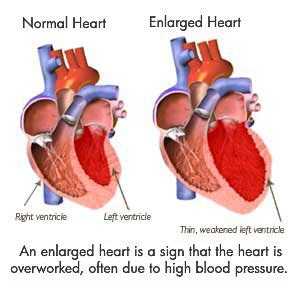 Can Enlarged Hearts Return To Normal Size After Heart Surgery?