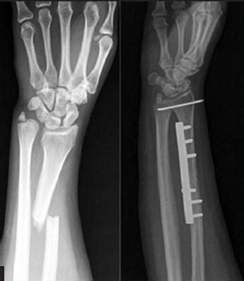 Orif Distal Radius Fracture