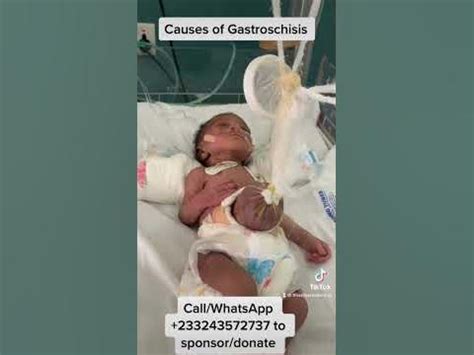 Causes of Gastroschisis - YouTube