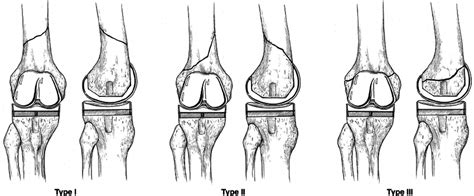 Anteroposterior and lateral views of supracondylar periprosthetic ...