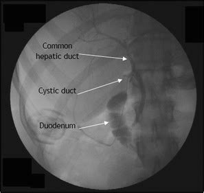 Intraoperative Cholangiogram - The Operative Review Of Surgery