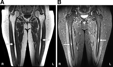 Femur Stress Fracture Mri