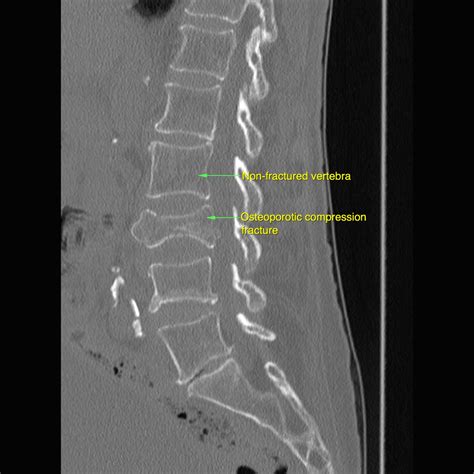 Can An Old Fracture Cause Pain