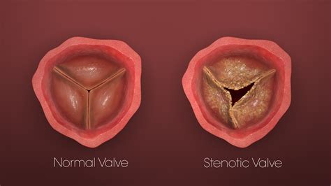 Transcatheter Heart Valves: How they revolutionized heart surgeries